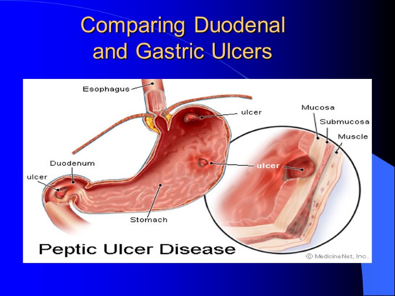 Comparing Duodenal  and Gastric Ulcers